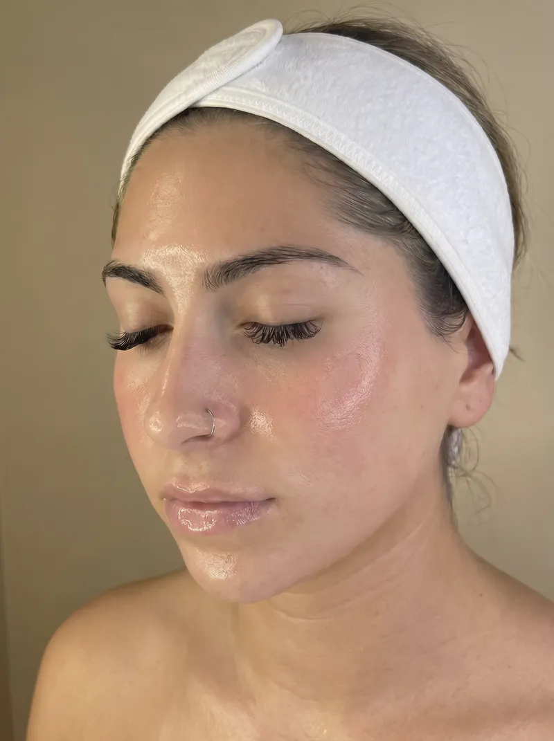 After Botox and Fillers