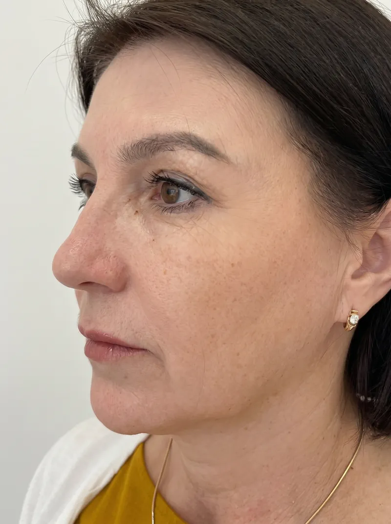 After Skin Rejuvenation